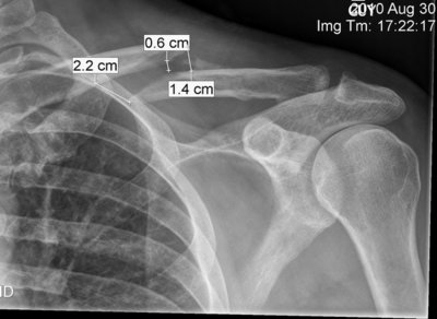 ERB ClavicleMarked0002b.jpg