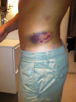 2012-07 Hip bruise_small.JPG